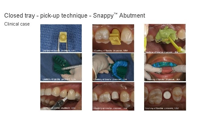 Closed tray - pick-up technique - Snappy™ Abutment Clinical case 