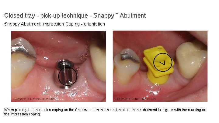 Closed tray - pick-up technique - Snappy™ Abutment Snappy Abutment Impression Coping - orientation