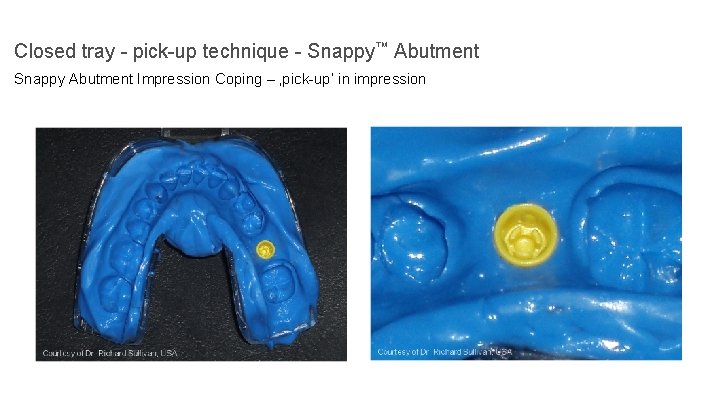 Closed tray - pick-up technique - Snappy™ Abutment Snappy Abutment Impression Coping – ‚pick-up‘