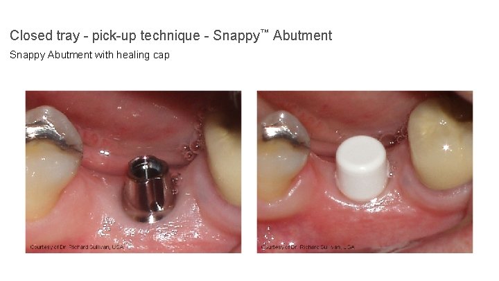 Closed tray - pick-up technique - Snappy™ Abutment Snappy Abutment with healing cap 