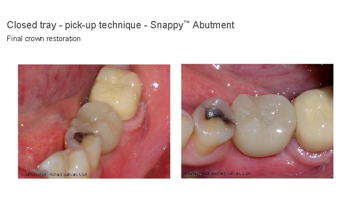 Closed tray - pick-up technique - Snappy™ Abutment Final crown restoration 