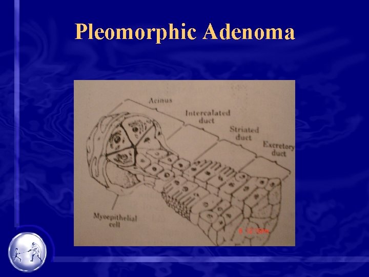 Pleomorphic Adenoma 