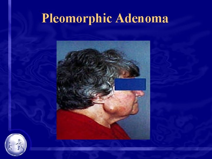 Pleomorphic Adenoma 