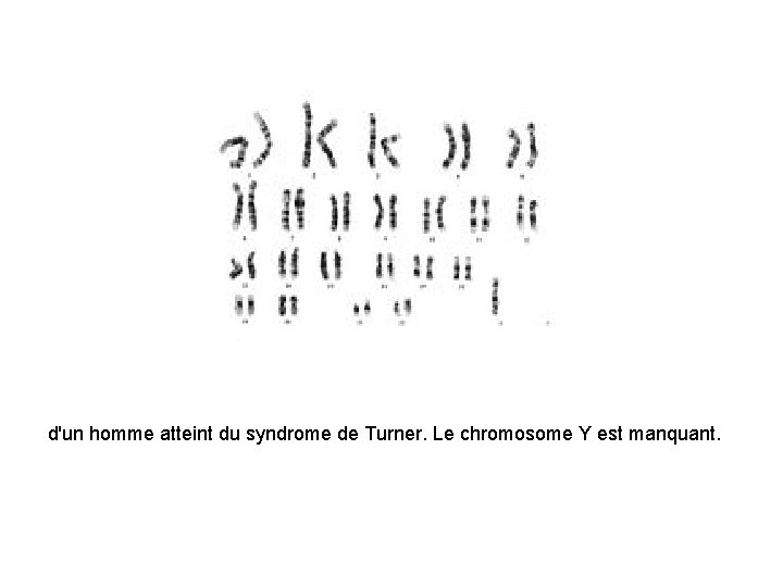 d'un homme atteint du syndrome de Turner. Le chromosome Y est manquant. 