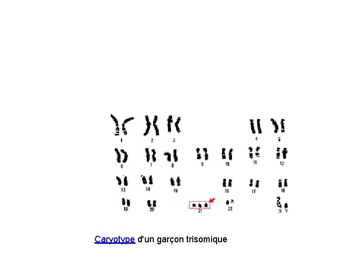 Caryotype d'un garçon trisomique 