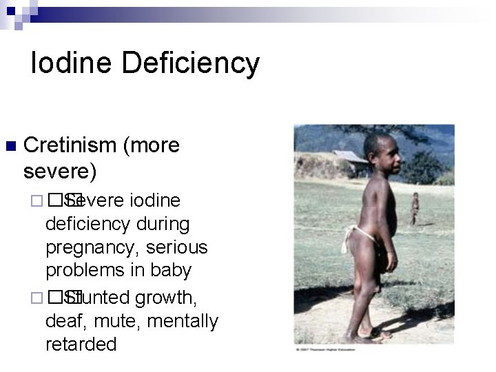 Iodine Deficiency n Cretinism (more severe) ¨ �� Severe iodine deficiency during pregnancy, serious