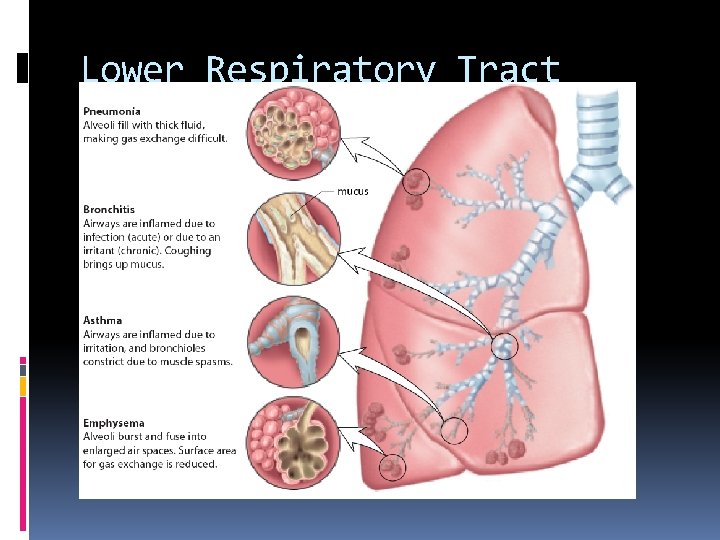 Lower Respiratory Tract Disorders 