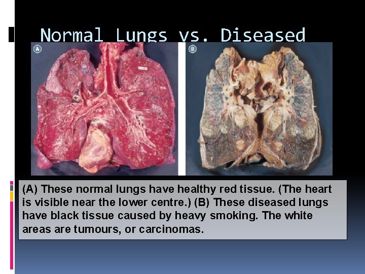 Normal Lungs vs. Diseased Lungs (A) These normal lungs have healthy red tissue. (The