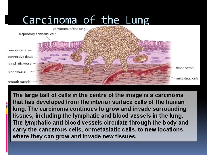 Carcinoma of the Lung The large ball of cells in the centre of the