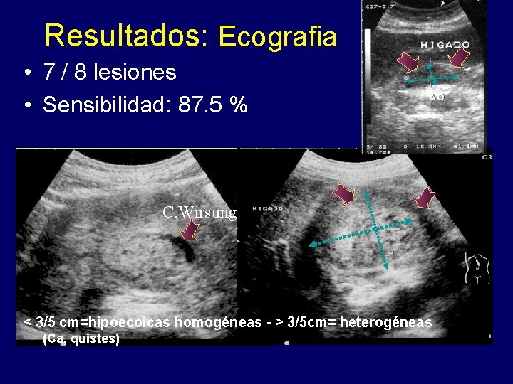 Resultados: Ecografia • 7 / 8 lesiones • Sensibilidad: 87. 5 % C. Wirsung