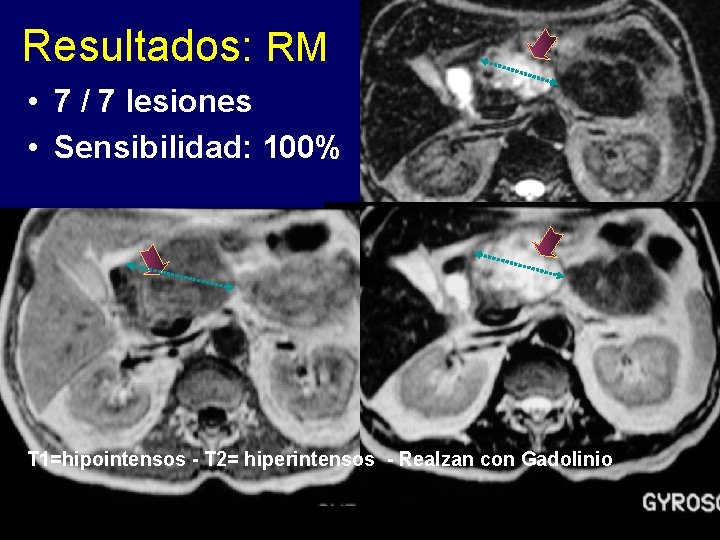 Resultados: RM • 7 / 7 lesiones • Sensibilidad: 100% T 1=hipointensos - T