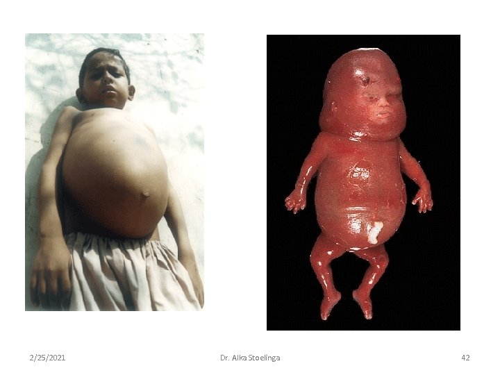 2/25/2021 Dr. Alka Stoelinga 42 2/25/2021 Dr. Alka Stoelinga 42