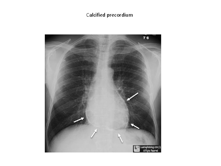 Calcified precordium 