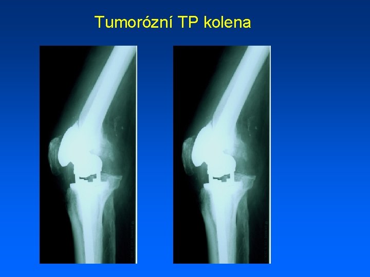 Tumorózní TP kolena 