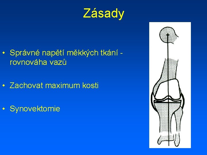 Zásady • Správné napětí měkkých tkání rovnováha vazů • Zachovat maximum kosti • Synovektomie