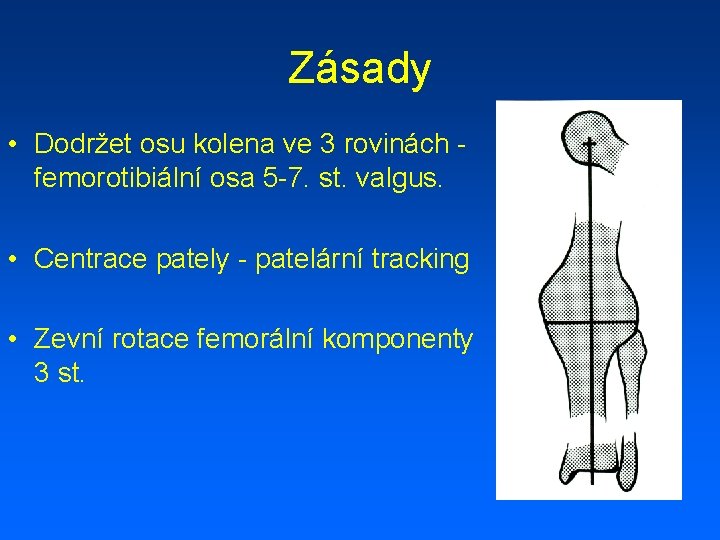 Zásady • Dodržet osu kolena ve 3 rovinách femorotibiální osa 5 -7. st. valgus.