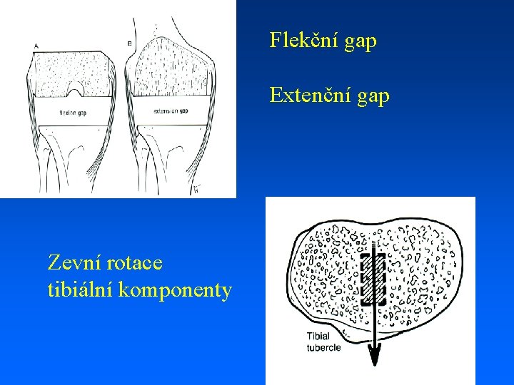 Flekční gap Extenční gap Zevní rotace tibiální komponenty 