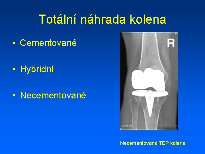 Totální náhrada kolena • Cementované • Hybridní • Necementované Necementovaná TEP kolena 