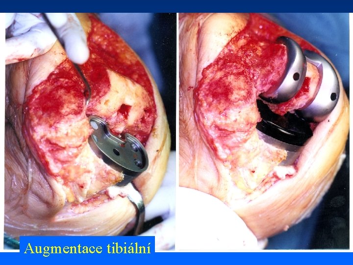 Augmentace tibiální 