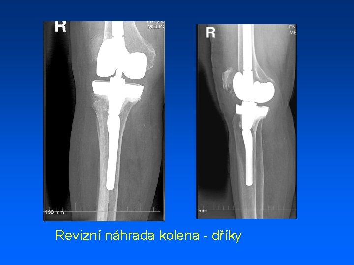 Revizní náhrada kolena - dříky 