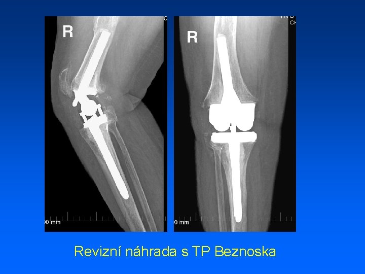 Revizní náhrada s TP Beznoska 