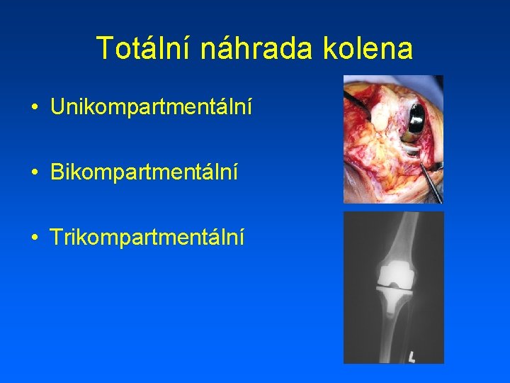 Totální náhrada kolena • Unikompartmentální • Bikompartmentální • Trikompartmentální 