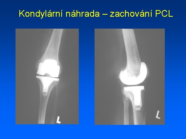 Kondylární náhrada – zachování PCL 