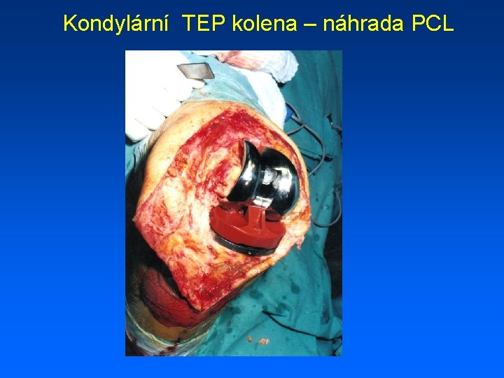 Kondylární TEP kolena – náhrada PCL 