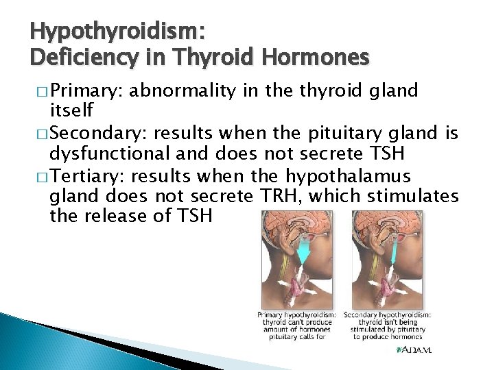 Hypothyroidism: Deficiency in Thyroid Hormones � Primary: abnormality in the thyroid gland itself �