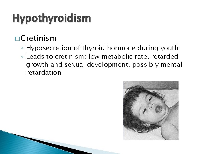 Hypothyroidism � Cretinism ◦ Hyposecretion of thyroid hormone during youth ◦ Leads to cretinism: