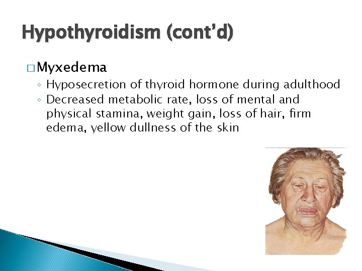 Hypothyroidism (cont’d) � Myxedema ◦ Hyposecretion of thyroid hormone during adulthood ◦ Decreased metabolic