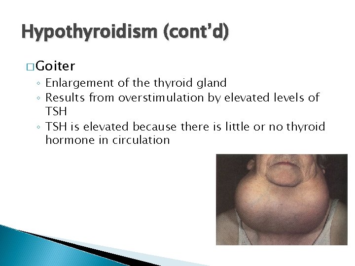 Hypothyroidism (cont’d) � Goiter ◦ Enlargement of the thyroid gland ◦ Results from overstimulation