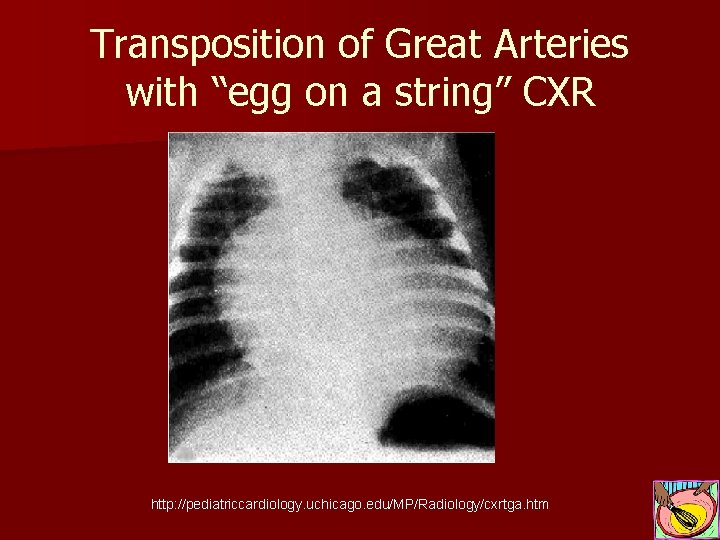 Transposition of Great Arteries with “egg on a string” CXR http: //pediatriccardiology. uchicago. edu/MP/Radiology/cxrtga.