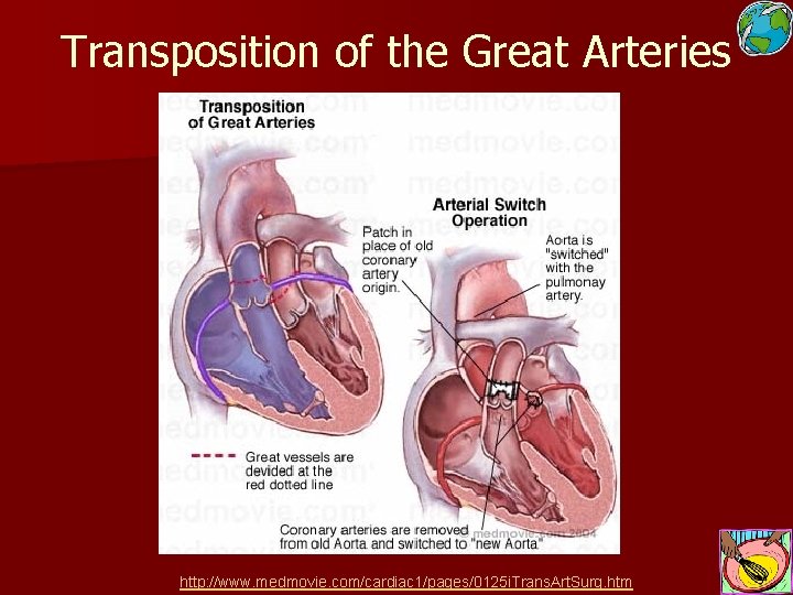 Transposition of the Great Arteries http: //www. medmovie. com/cardiac 1/pages/0125 i. Trans. Art. Surg.