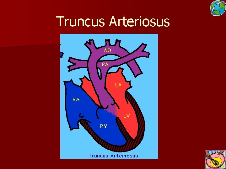 Truncus Arteriosus 