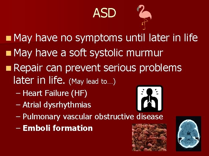 ASD n May have no symptoms until later in life n May have a