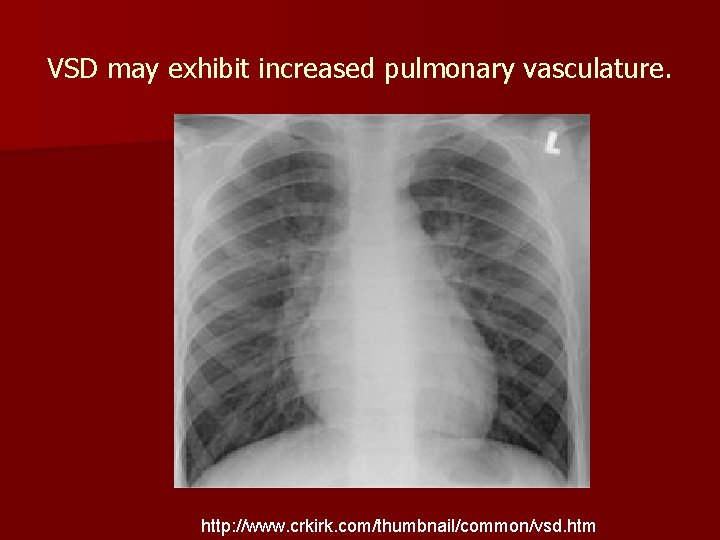 VSD may exhibit increased pulmonary vasculature. http: //www. crkirk. com/thumbnail/common/vsd. htm 