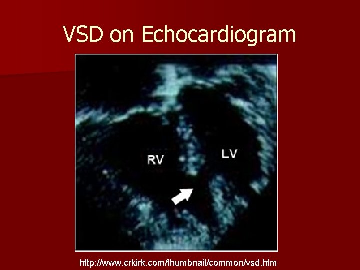 VSD on Echocardiogram http: //www. crkirk. com/thumbnail/common/vsd. htm 