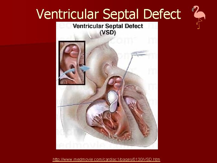 Ventricular Septal Defect http: //www. medmovie. com/cardiac 1/pages/0130 i. VSD. htm 