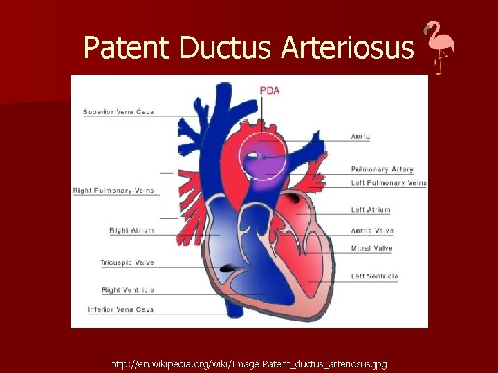 Patent Ductus Arteriosus http: //en. wikipedia. org/wiki/Image: Patent_ductus_arteriosus. jpg 