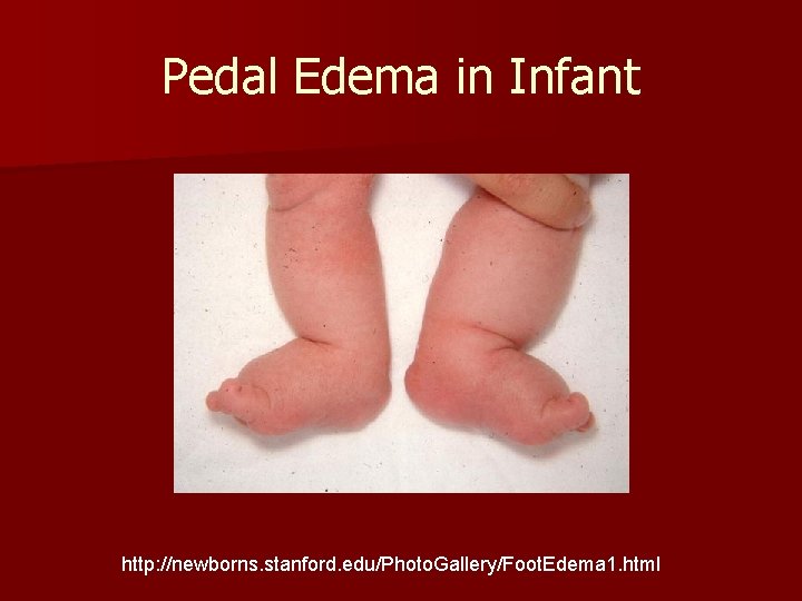 Pedal Edema in Infant http: //newborns. stanford. edu/Photo. Gallery/Foot. Edema 1. html 