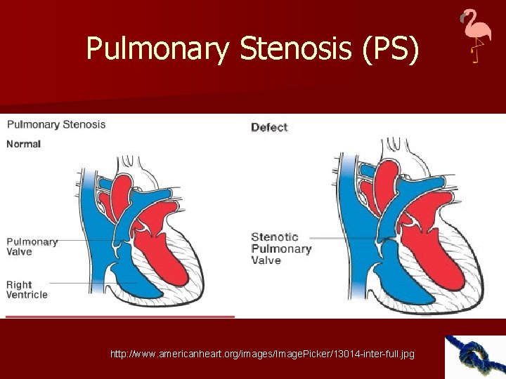 Pulmonary Stenosis (PS) http: //www. americanheart. org/images/Image. Picker/13014 -inter-full. jpg 