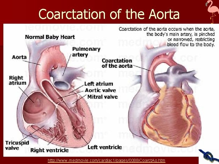 Coarctation of the Aorta http: //www. medmovie. com/cardiac 1/pages/0088 i. Coarct. Ao. htm 