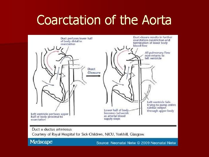 Coarctation of the Aorta 
