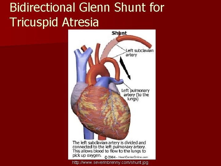 Bidirectional Glenn Shunt for Tricuspid Atresia http: //www. severinbrenny. com/shunt. jpg 