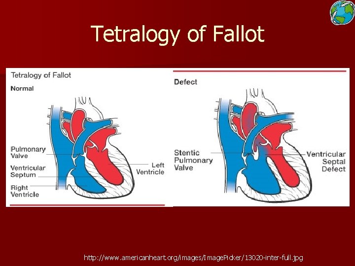 Tetralogy of Fallot http: //www. americanheart. org/images/Image. Picker/13020 -inter-full. jpg 