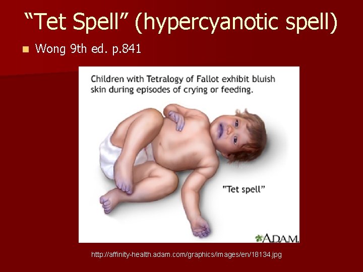 “Tet Spell” (hypercyanotic spell) n Wong 9 th ed. p. 841 http: //affinity-health. adam.