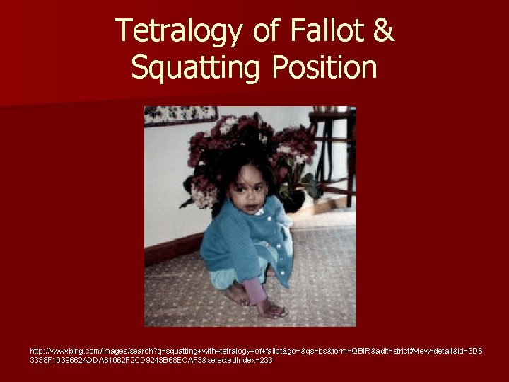 Tetralogy of Fallot & Squatting Position http: //www. bing. com/images/search? q=squatting+with+tetralogy+of+fallot&go=&qs=bs&form=QBIR&adlt=strict#view=detail&id=3 D 6 3338