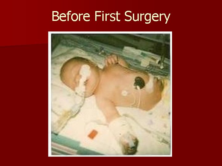 Before First Surgery 