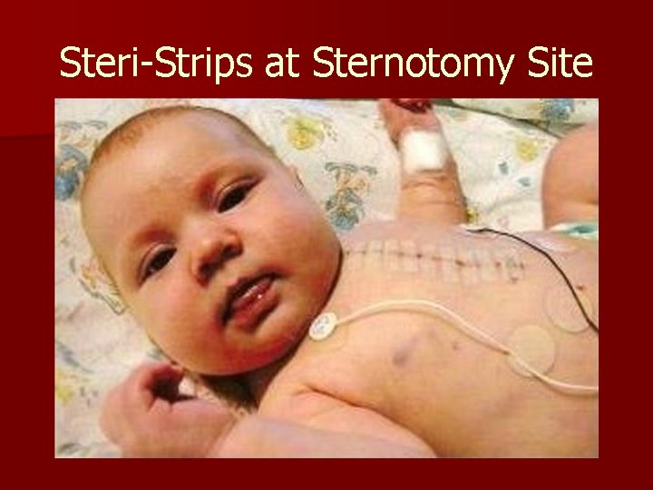 Steri-Strips at Sternotomy Site 